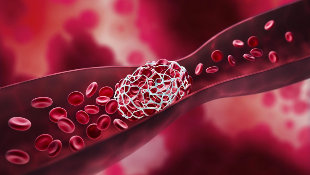 Imagem de um coágilo bloqueando a corrente sanguínea em uma ilustração 3D para representar a trombose. 