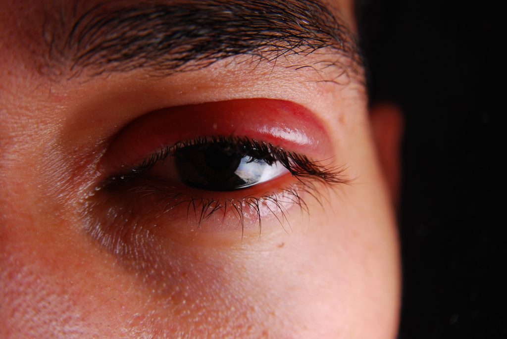 Olhos inchados: 8 dicas para aliviar o incômodo