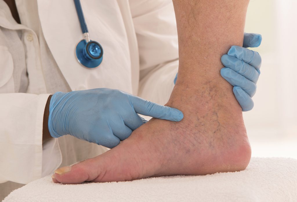 Foto de um médico examinando o pé de um paciente que está com inchaço nas pernas.  